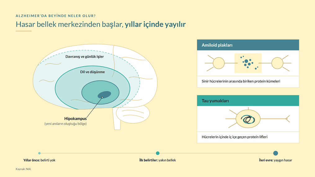 Alzheimer'da hasarın hipokampustan başlayıp beynin diğer bölgelerine yayılması; sinir hücreleri arasında amiloid plakları ve hücre içinde tau yumakları