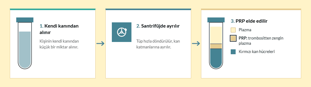PRP nasıl hazırlanır: kişinin kendi kanından alınır, santrifüjde ayrılır, trombositten zengin plazma elde edilir