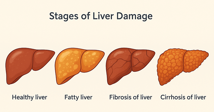 stages of liver damage illustration